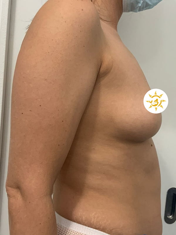 Breast surgery​ - Before