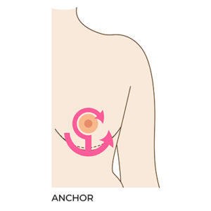 Breast Reduction Surgery Anchor Type Incision 