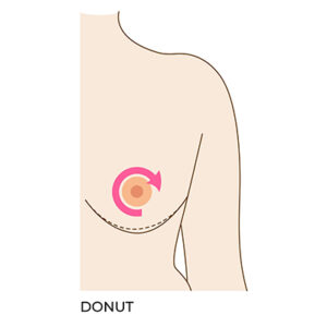 Breast Reduction Surgery Donut Type Incision