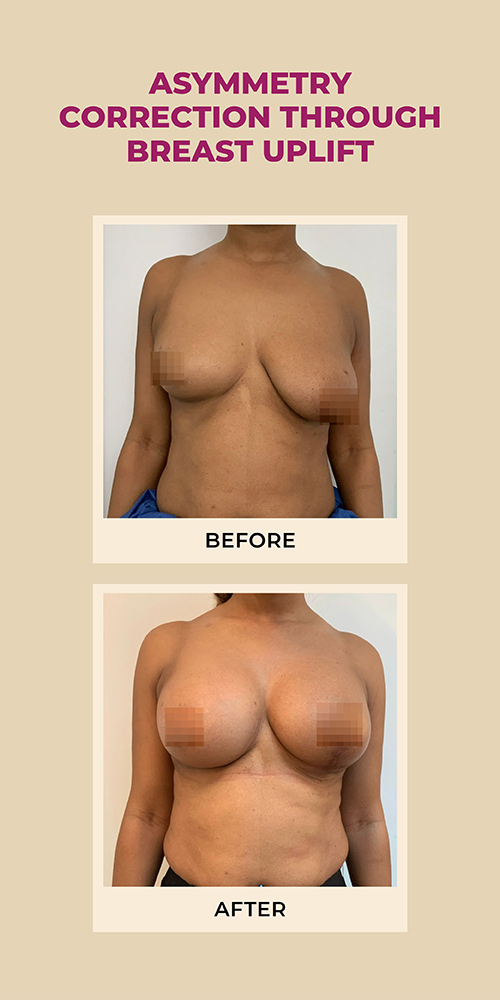 ASYMMETRY CORRECTION THROUGH BREAST UPLIFT