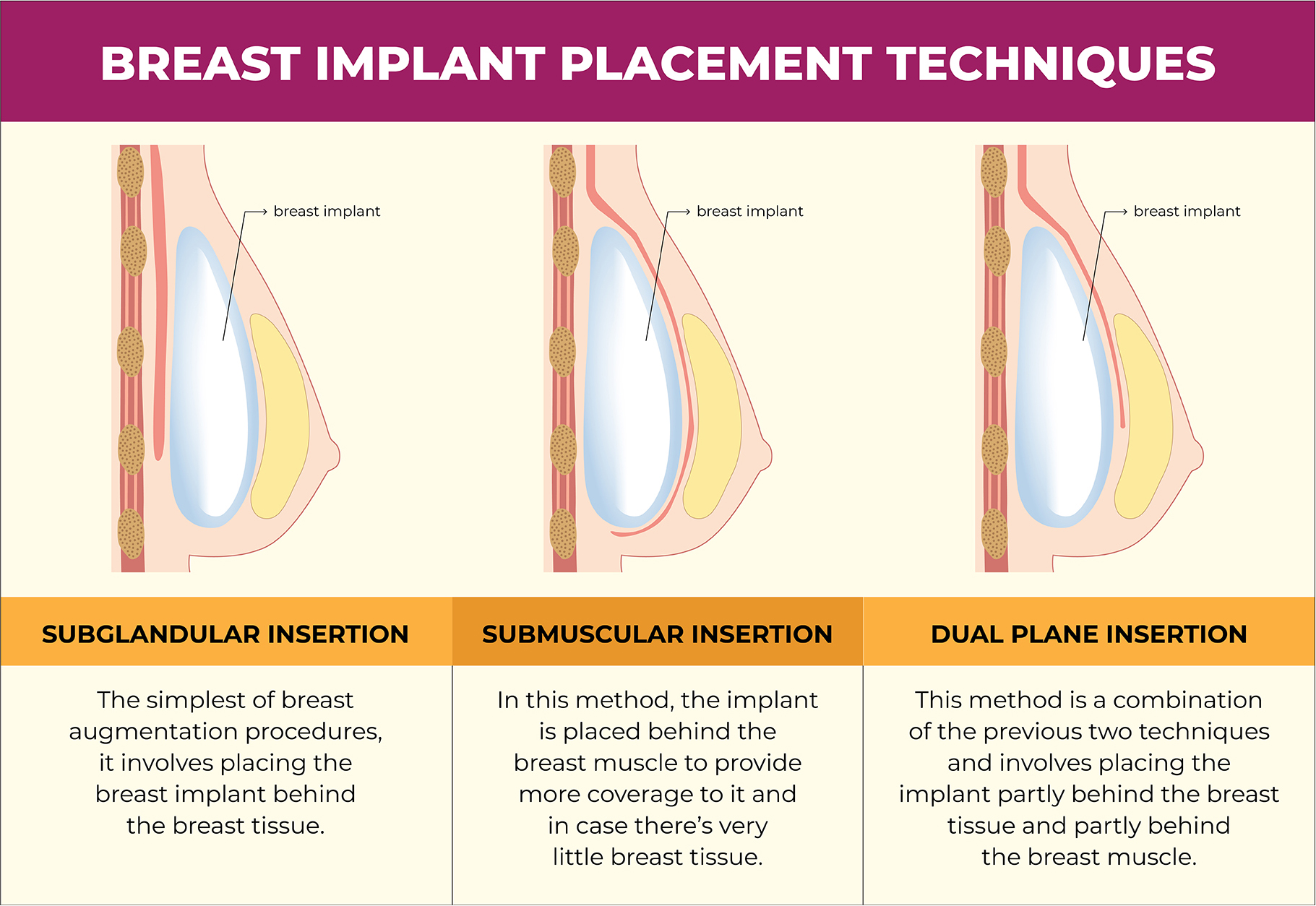 Three types of breast implant placement techniques