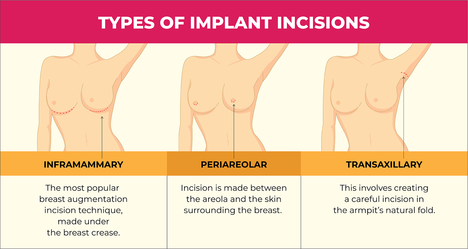 Common breast augmentation incisions used to insert implants