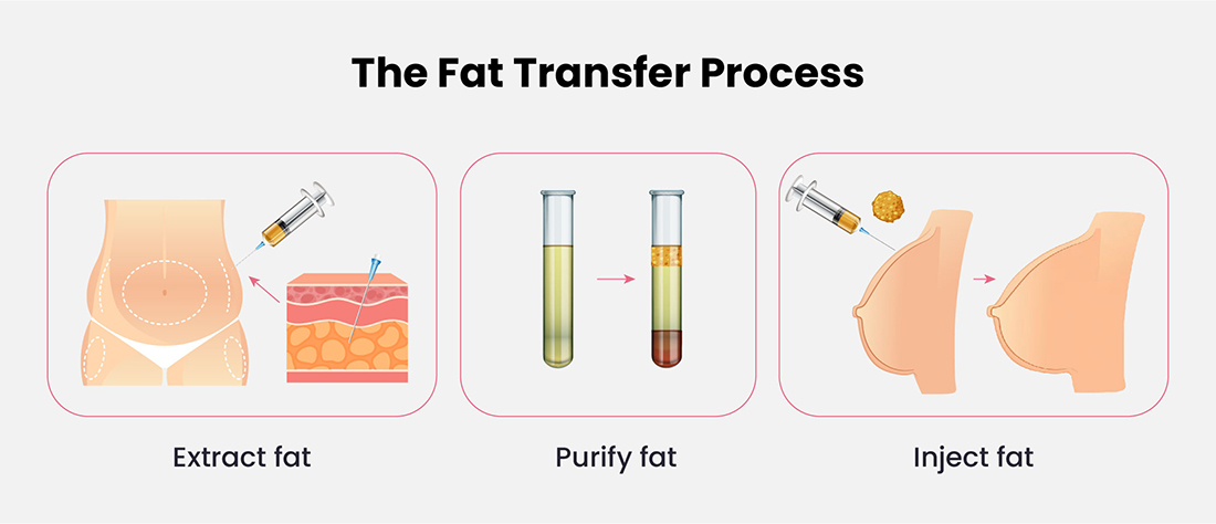 The Fat Transfer Process