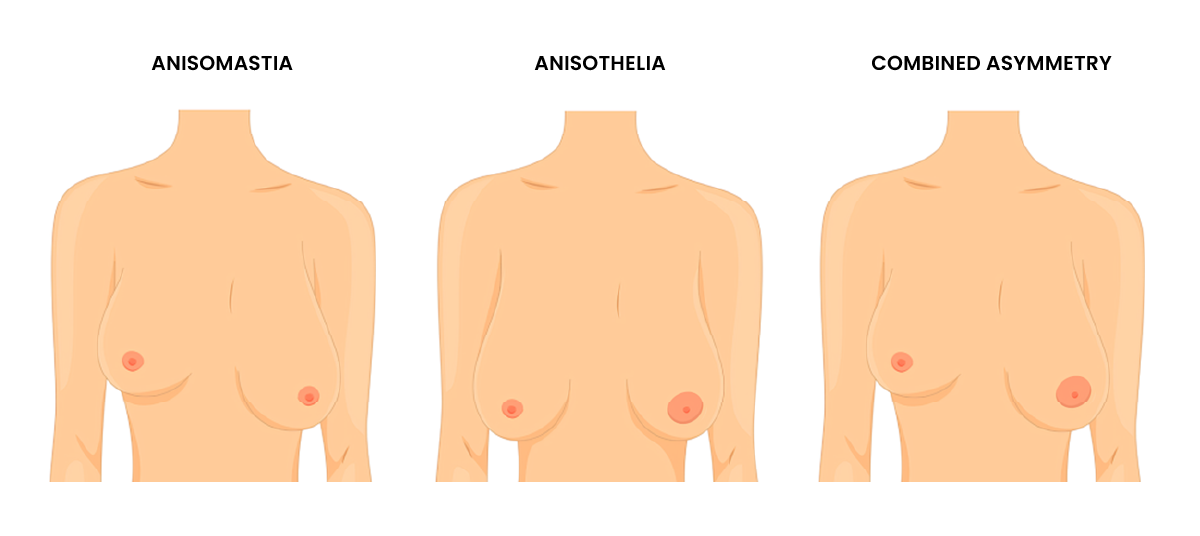 Types of Asymmetry