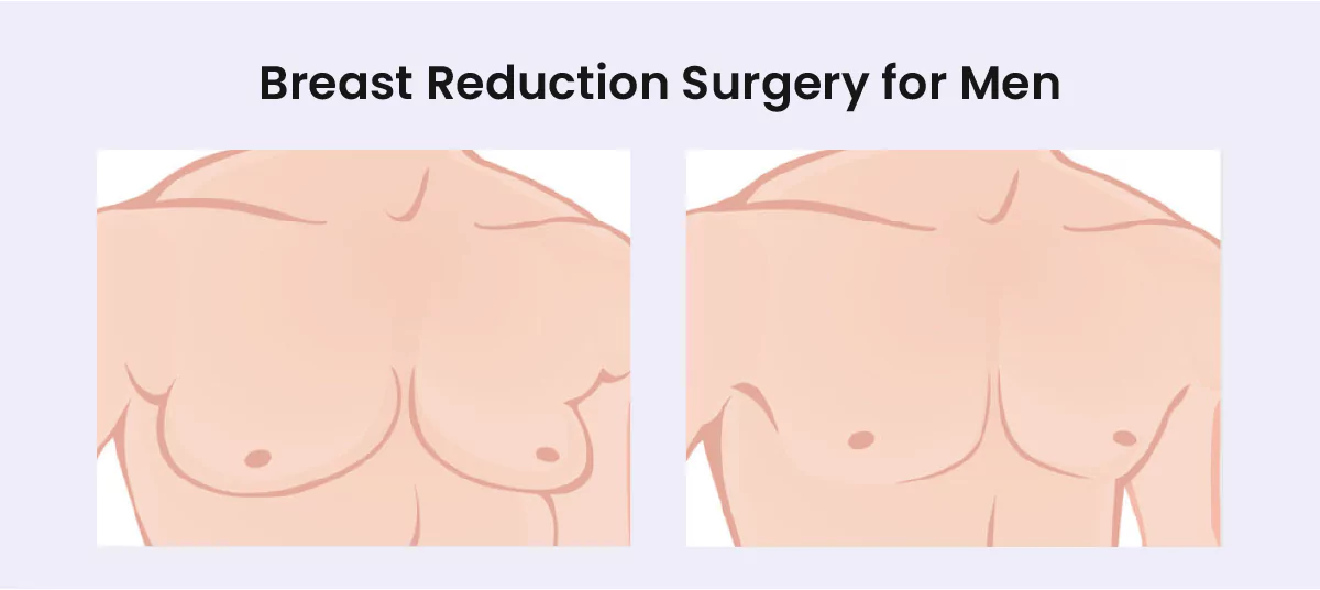 breast reduction surgery for men